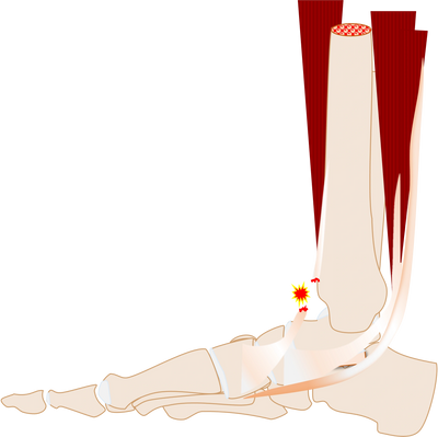 Anterior Tibial Tendon | Nicholas Strasser MD